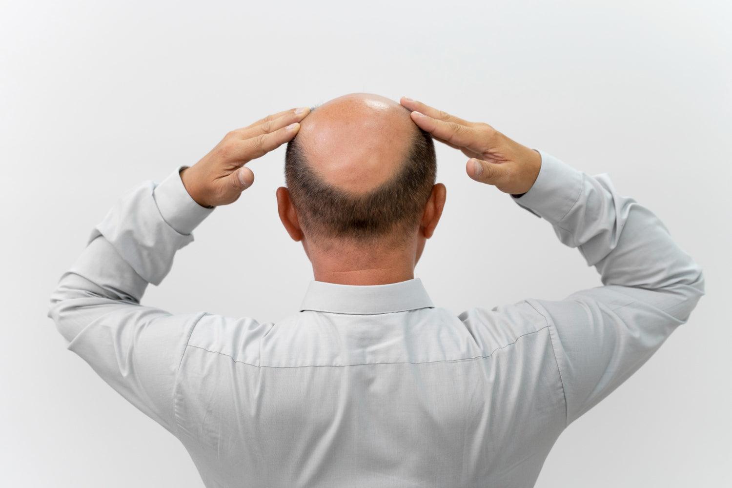 Com medo de ficar calvo? Saiba quais são os sinais da calvície masculina