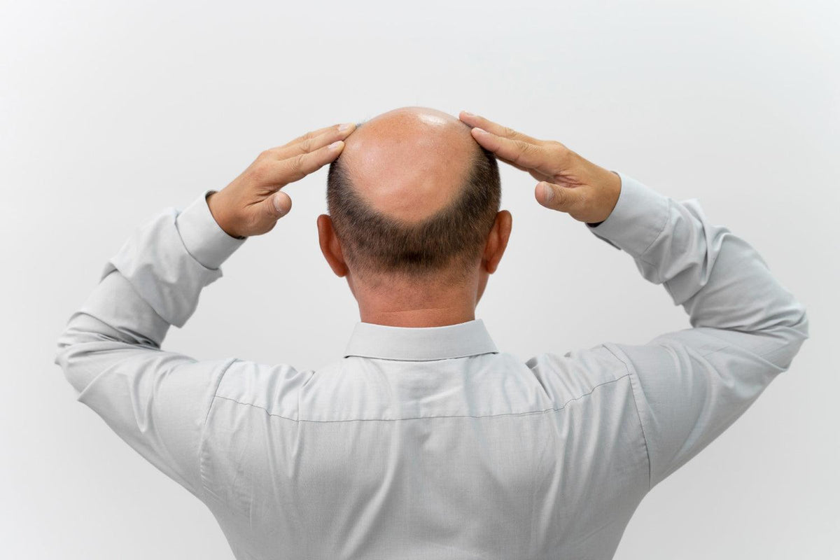 Com medo de ficar calvo? Saiba quais são os sinais da calvície masculina